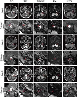 Diagnostic potential of routine brain MRI and high-resolution, multi-contrast vessel wall imaging in the detection of internal carotid artery dissection